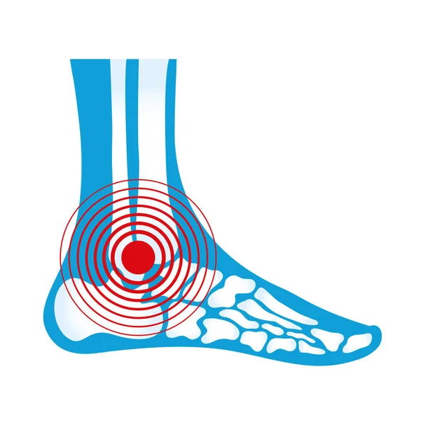 Rheumatologische Schmerzen am Knöchel — Stockvektor