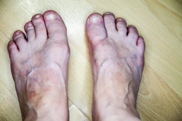 Hallux valgus, bunion in elderly foot on floor.Abnormal of foot shape from deformity joint connecting the big toe.