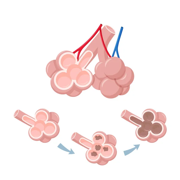 Pulmones humanos alvéolos — Archivo Imágenes Vectoriales