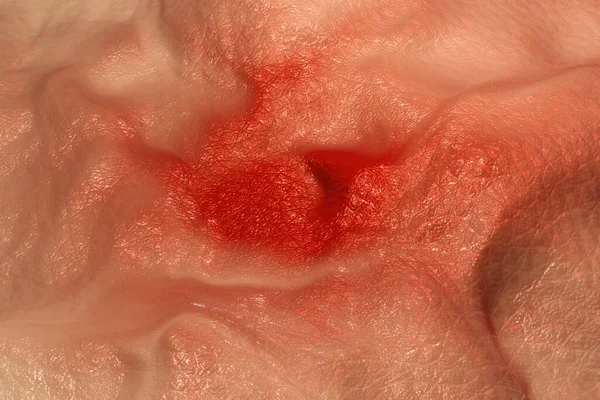3D-иллюстрация воспаления кожи — стоковое фото