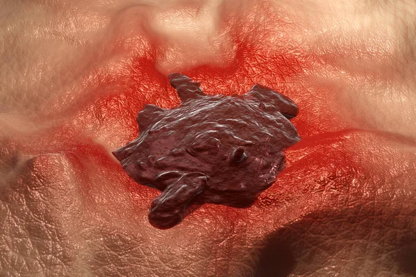 Skin cancer 3D Illustration closeup