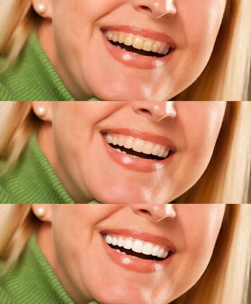 Mujer Sonriente Mostrando Dientes Progresivos Blanqueamiento Blanqueamiento —  Fotos de Stock