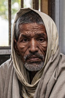 Sundarpur, Hindistan - 2013: Hindistan 'ın Bihar eyaletindeki yerel bir cüzzamlı hastanesinde kimliği belirsiz Hintli cüzzamlı hasta