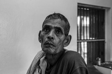 Sundarpur, Hindistan - 2013: Hindistan 'ın Bihar eyaletindeki yerel bir cüzzamlı hastanesinde kimliği belirsiz Hintli cüzzamlı hasta