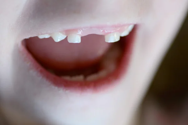 Pequeño niño sonriendo diente delantero perdido — Foto de Stock