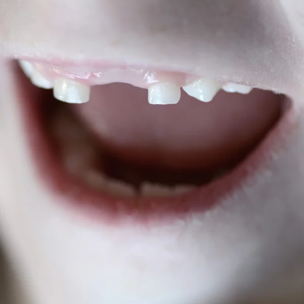 Маленький ребенок улыбается без переднего зуба — стоковое фото
