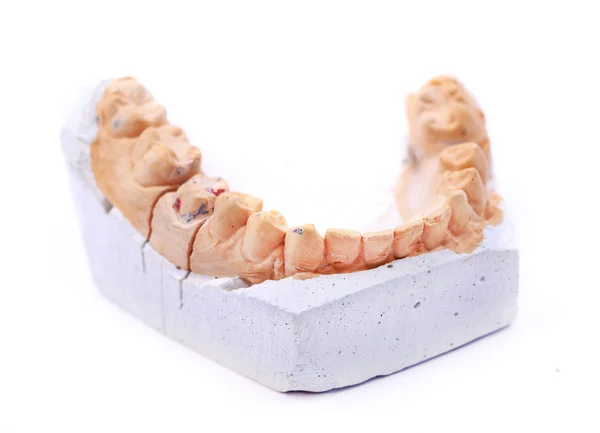 Gesso dentário — Fotografia de Stock