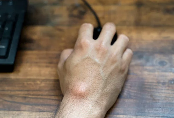 Ganglion cyste op mensenhand. Handcomputer muis vasthouden — Stockfoto