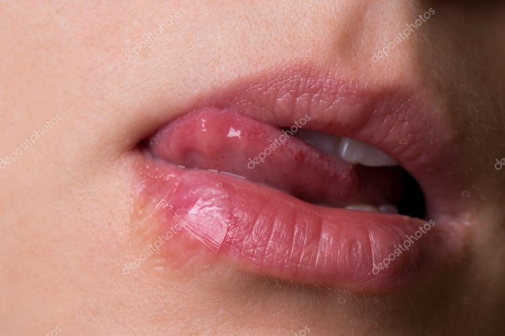 herpes på läppen behandling herpes på läppen behandling