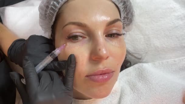Cosmetoloog arts is het maken van meerdere injecties biorevitalisatie met hyaluronzuur in de huid van de vrouw gezicht, close-up. Vrouw op de procedure van mesotherapie injectie — Stockvideo