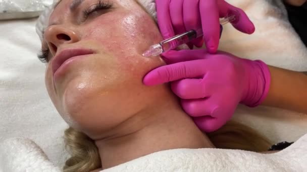 Омолаживающая процедура: профессиональный косметолог делает несколько инъекций женской коже лица во время мезотерапии. Биоревитализация и подтяжка лица — стоковое видео