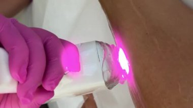 Estetisyen jel ve el yapımı lazer cihazı kullanarak bir kadının bacağını lazerle temizliyor.. 