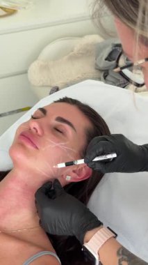 Estetikçi, genç bir kadının yüzündeki iplik kaldırma prosedüründen önce yüz hatlarını beyaz kalemle işaretliyor.