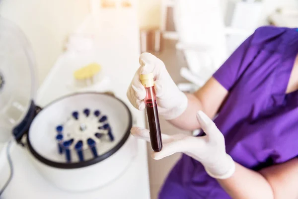 Preparación de plasma rico en plaquetas. Tubo con sangre en las manos —  Fotos de Stock