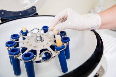 Trombosit zengini plazma hazırlığı. Ellerinde plazma olan tüp