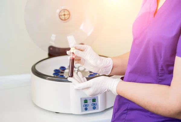 Preparación de plasma rico en plaquetas. Tubo con sangre en las manos —  Fotos de Stock