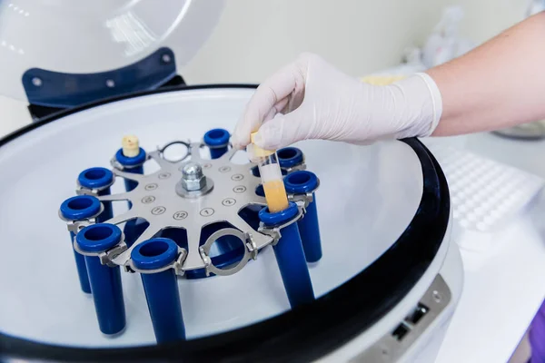 Preparación de plasma rico en plaquetas. Tubo con plasma en las manos —  Fotos de Stock