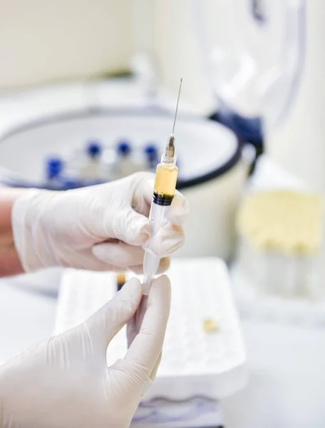 Preparación de plasma rico en plaquetas. Jeringa con plasma en las manos —  Fotos de Stock