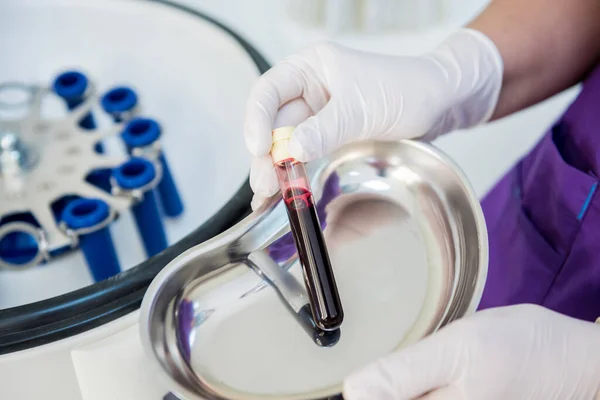 Preparación de plasma rico en plaquetas. Tubo con sangre en las manos —  Fotos de Stock