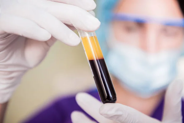 Platelet-Rich plasma preparation. Tube with plasma in hands