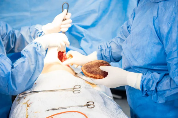 Breast augmentation under the guidance surgeons team in surgical operating room. — Stock Photo, Image