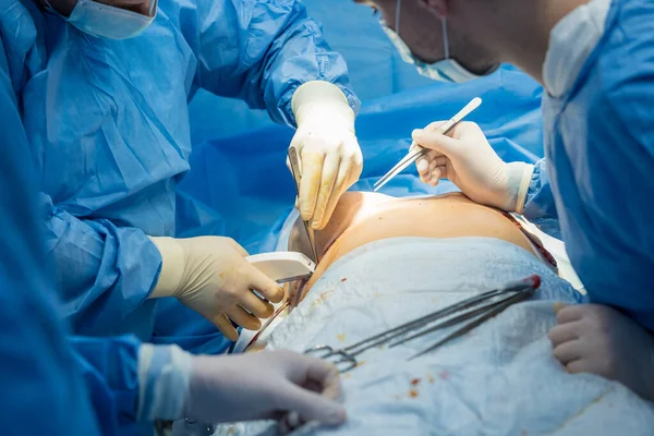 Aumento del seno sotto la guida chirurghi team in sala operatoria chirurgica. — Foto Stock