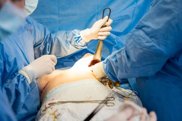 Aumento da mama sob a orientação da equipe de cirurgiões na sala cirúrgica. — Fotografia de Stock