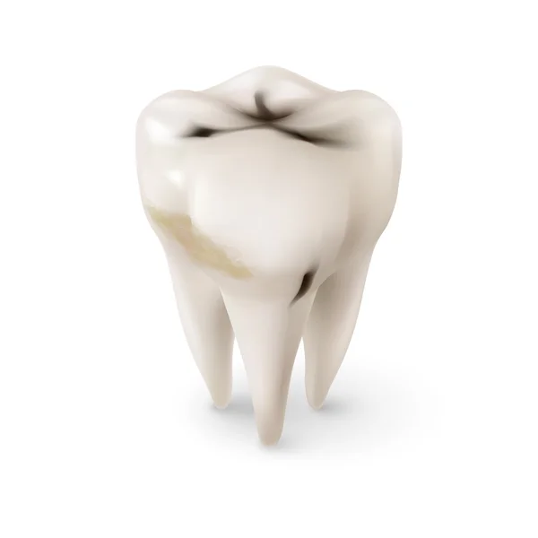 Conceito Isométrico de Dente Humano com Cárie sobre Branco — Vetor de Stock