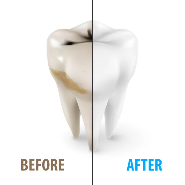 Teeth Whitening pictogram, symbool van de tandarts in isometrisch stijl op wit — Stockvector