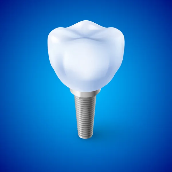 Isometrische Concept van menselijke Dental Implant op blauw — Stockvector