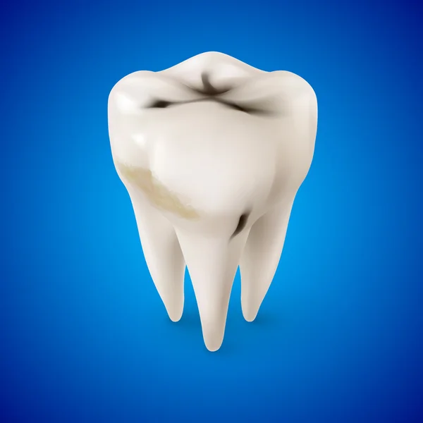 Isometrische Concept van menselijke tand met cariës op blauw — Stockvector