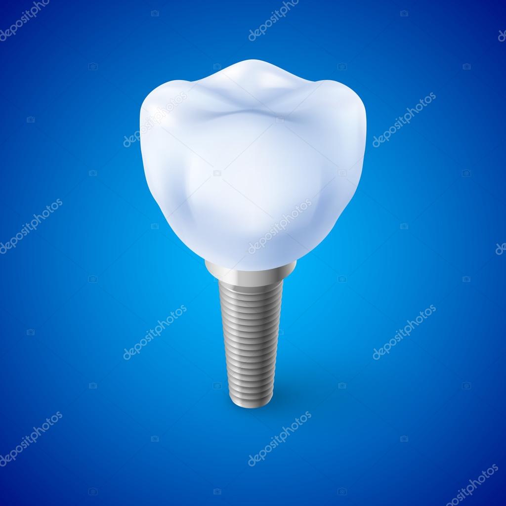 Isometric Concept of Human Dental Implant on Blue