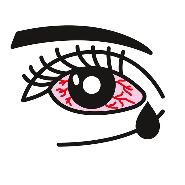 Ojo inflamado Conjuntivitis u ojo rosa — Vector de stock