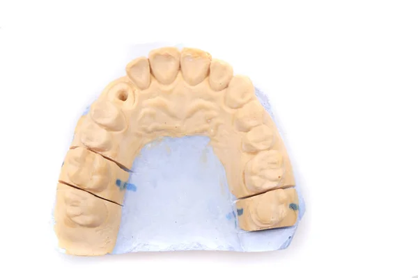 Modelo Prótese Dentária Isolada Fundo Branco — Fotografia de Stock