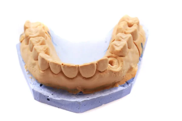 Modell Der Zahnprothese Isoliert Auf Weißem Hintergrund — Stockfoto