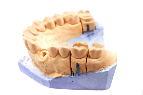 Modell Der Zahnprothese Isoliert Auf Weißem Hintergrund — Stockfoto