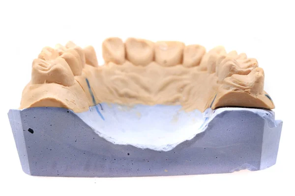 Modelo Prótesis Dental Aislada Sobre Fondo Blanco —  Fotos de Stock