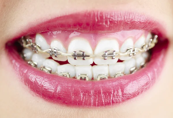 Girl with braces Stock Image