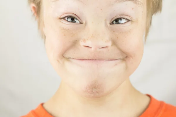 The Face of Downs Syndrome — Stock Photo, Image