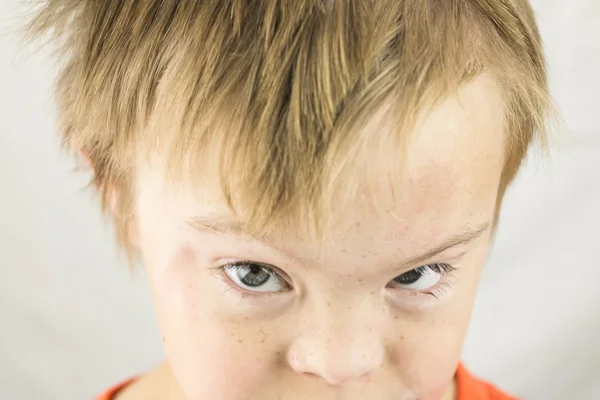 The Face of Downs Syndrome — Stock Photo, Image