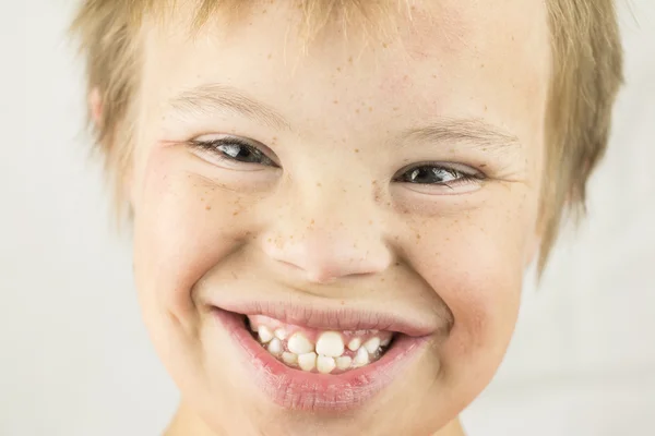 The Face of Downs Syndrome — Stock Photo, Image