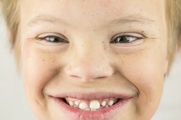 The Face of Downs Syndrome — Stock Photo, Image