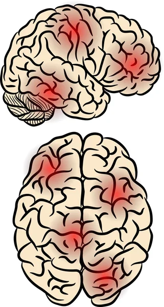 Febre cerebral — Vetor de Stock