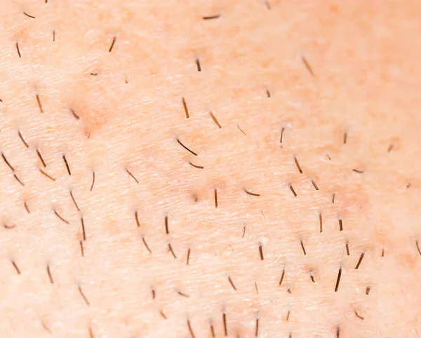 Bristles on the skin. close-up — Stock Photo, Image