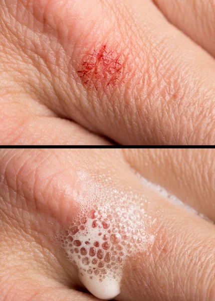 Sår på den mänskliga huden. makro — Stockfoto