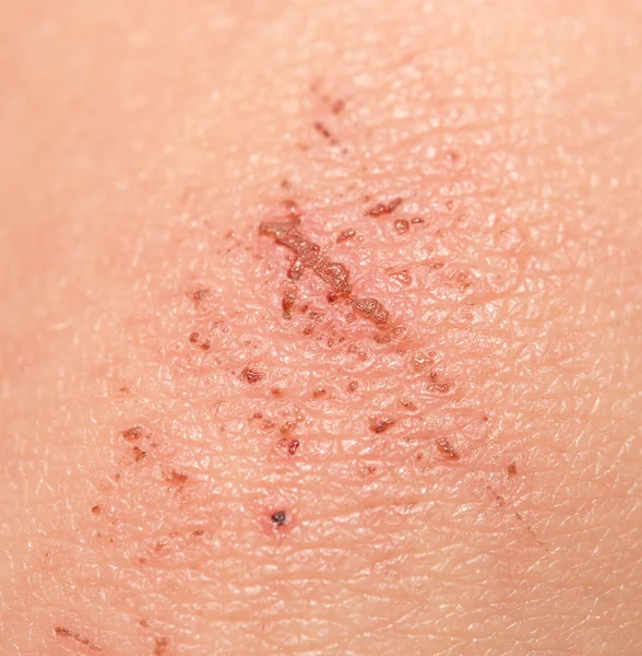 A wound on the skin. close — Stock Photo, Image