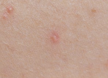 sivilce cilt üzerinde. Kapat