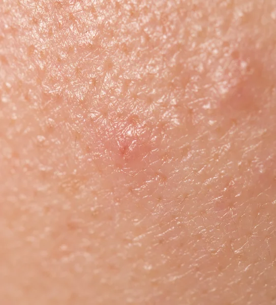 Pimples on the skin. close — Stock Photo, Image