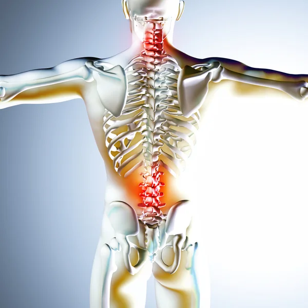 3D ιατρική απεικόνιση δείχνει τον πόνο στην πλάτη — Φωτογραφία Αρχείου