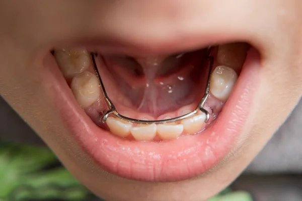 Chico joven teniendo un mantenedor del espacio dental en su boca — Foto de Stock